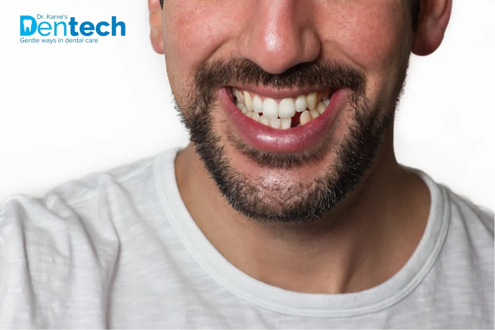 Missing Teeth Ill-Effects and Solutions